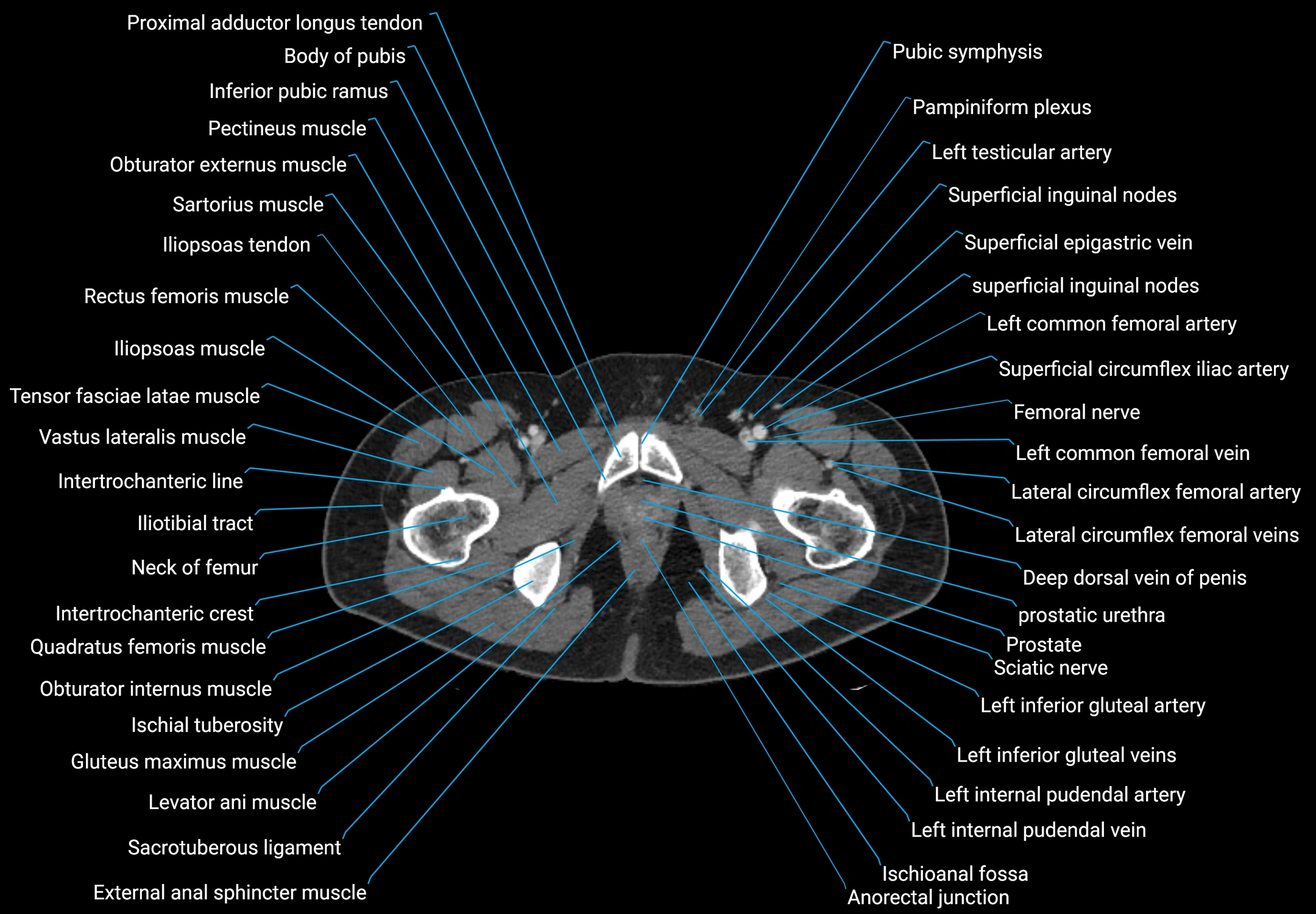 CT male pelvis axial cross sectional anatomy labelled radiology image -00202.webp